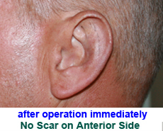 plastic-surgery-prominent-ear 